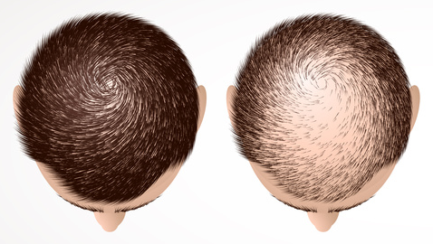 Schütthaar vor einer Haartransplantation? Die besten Tipps gegen Haarausfall!