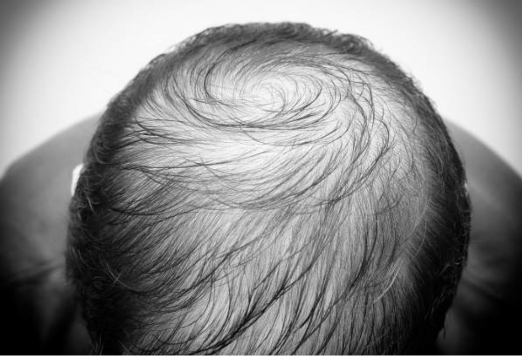 Wie lange hält eine Haartransplantation - LEON MIGUEL